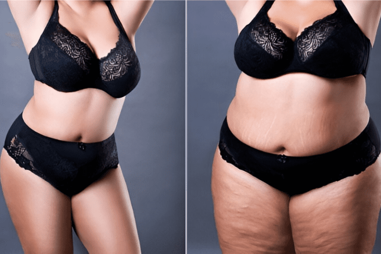 Final Results After a Tummy Tuck - How Long Is the Recovery?