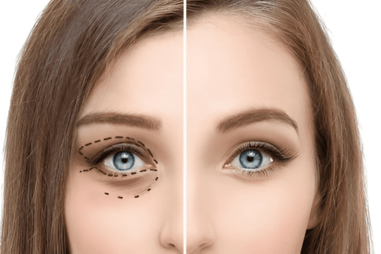 Ptosis Droopy Eyelid Surgery - Blepharoplasty Benefits, Recovery