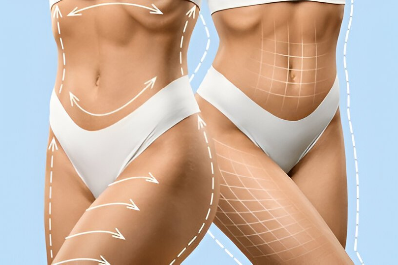 Laser Smart Lipo Treatment - Achieve Precision Fat Reduction and Enhanced Contouring