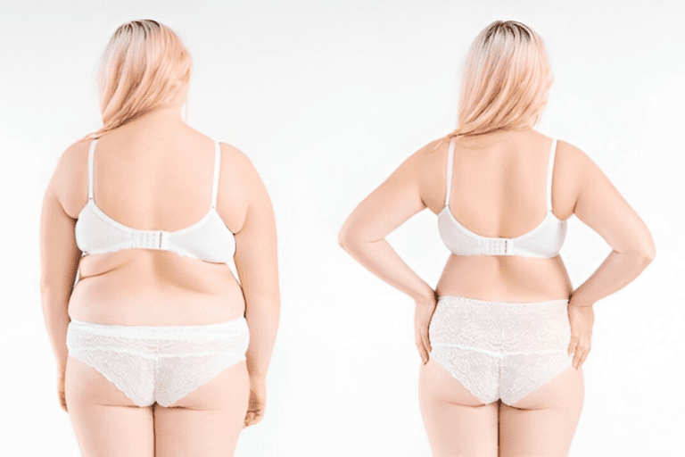 Laser Smart Lipo Treatment - Minimally Invasive Fat Reduction