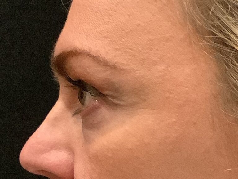 Eyelid Lift Surgery Before and After Image 3