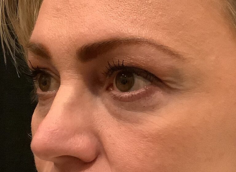 Eyelid Lift Surgery Before and After Image 1