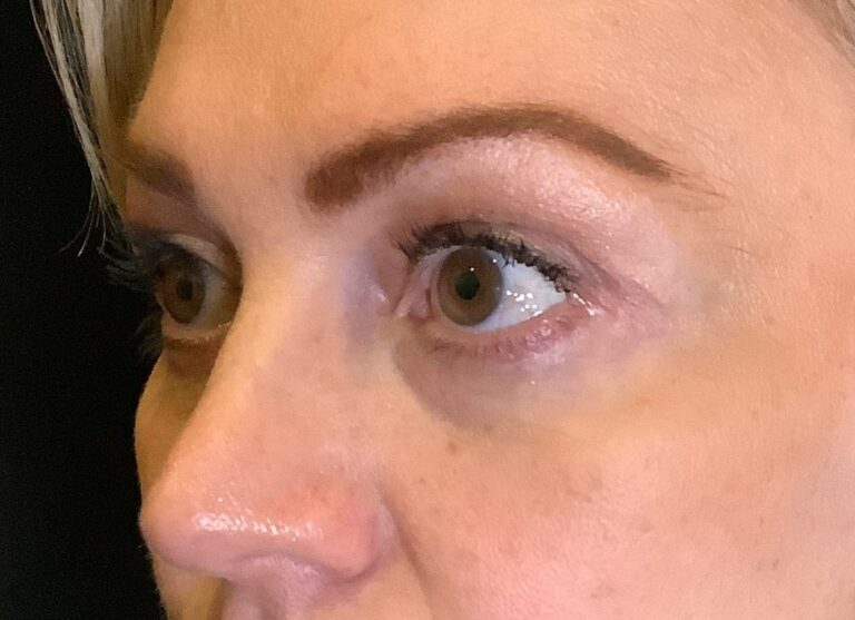 Facial plastic surgery Tampa_Eyelid Lift Surgery Before and After Image 2