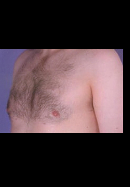 Male Breast Reduction Before and After Results – Case 7