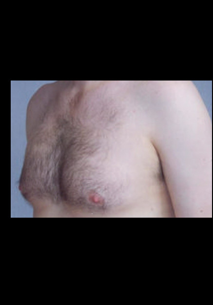 Male Breast Reduction Before – Case 7