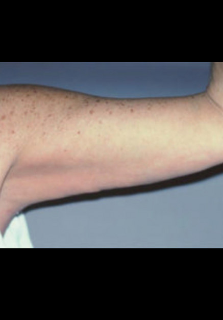 Arm Lift – Case 1