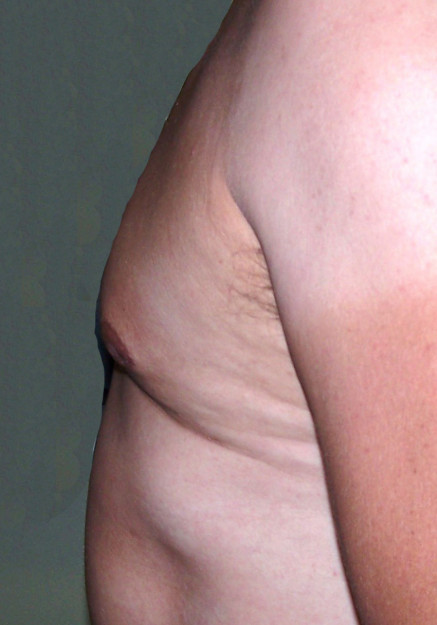 Male Breast Reduction – Case 1