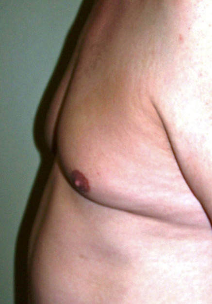 Male Breast Reduction – Case 1