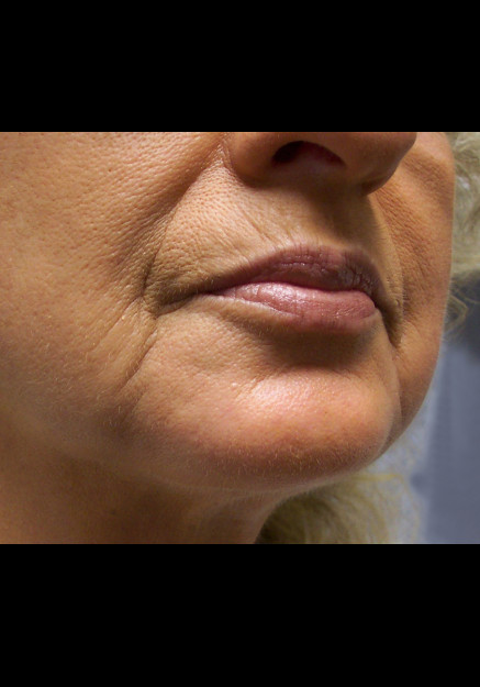 Chin Implants – Case 1