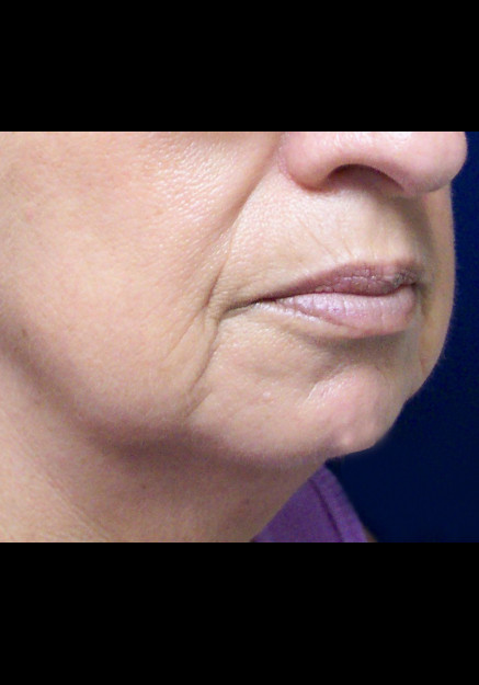 Chin Implants – Case 1