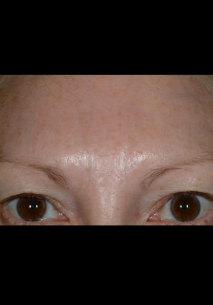 Botox – Case 1