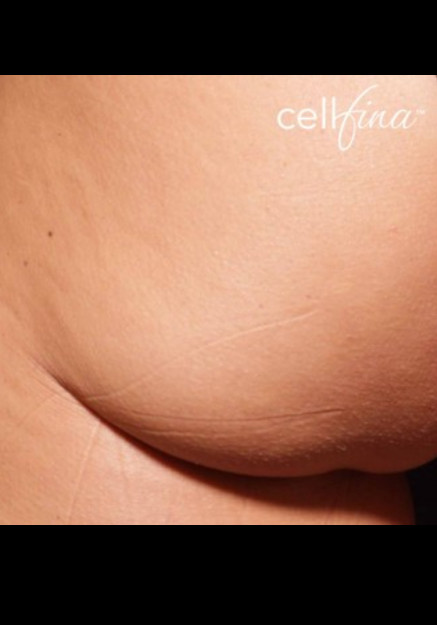 Cellfina – Case 1