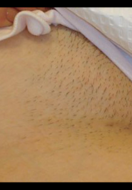 Hair Removal – Case 1