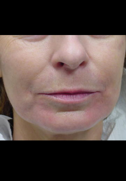 Restylane – Case 1