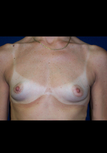 Breast Augmentation – Case 3