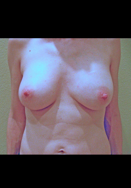 Breast Augmentation – Case 6
