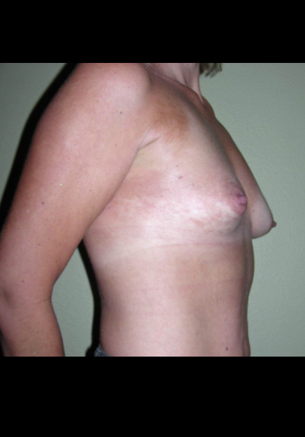 Breast Augmentation – Case 7