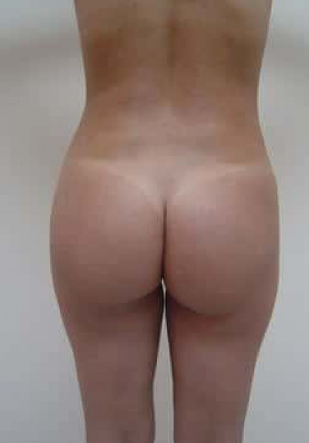 Brazilian Butt Lift – Case 1