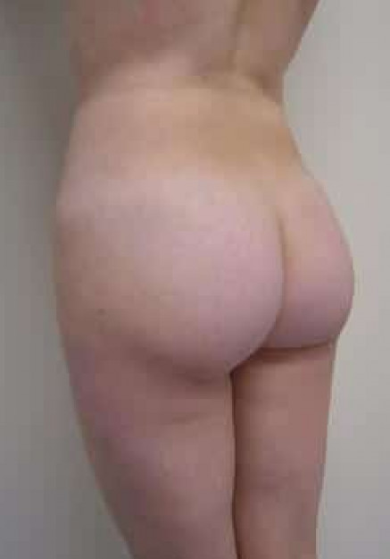 Brazilian Butt Lift – Case 2
