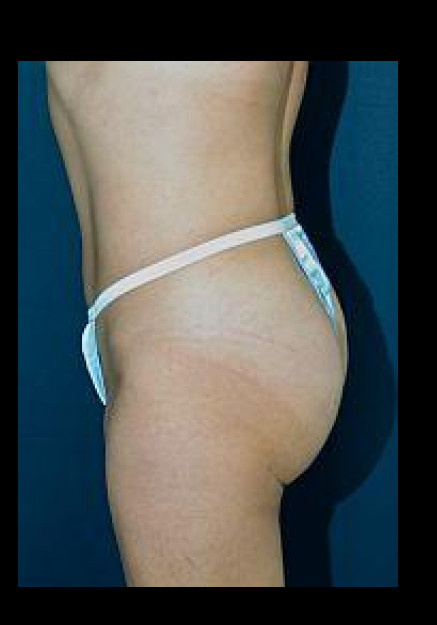 Brazilian Butt Lift – Case 3