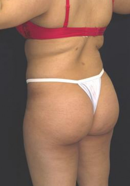 Brazilian Butt Lift – Case 4