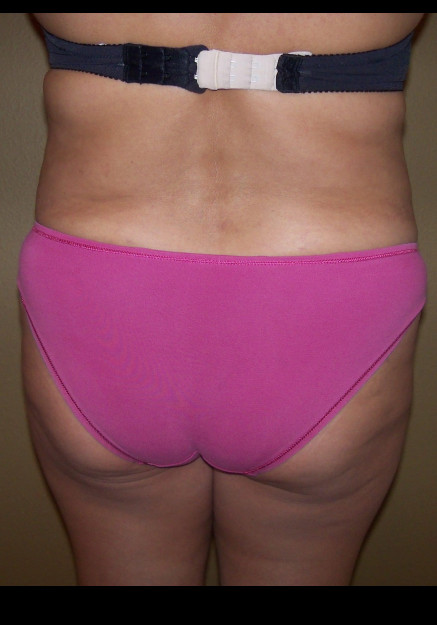 Brazilian Butt Lift – case 5