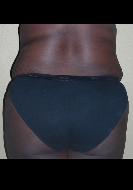 Brazilian Butt Lift – Case 6