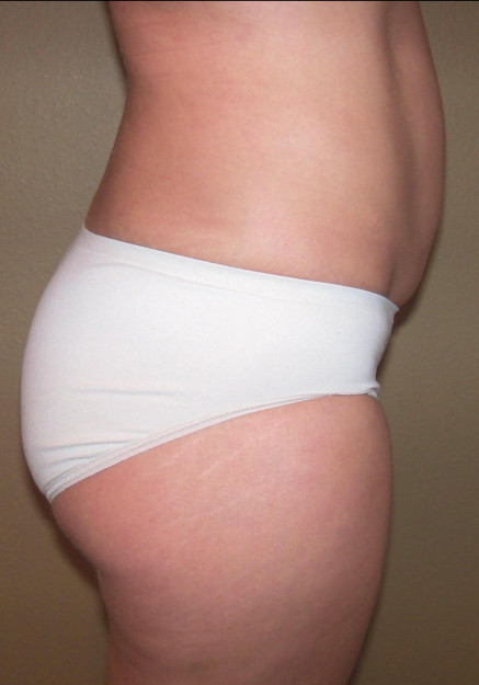 Brazilian Butt Lift – Case 8