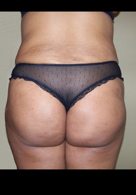 Brazilian Butt Lift – Case 9