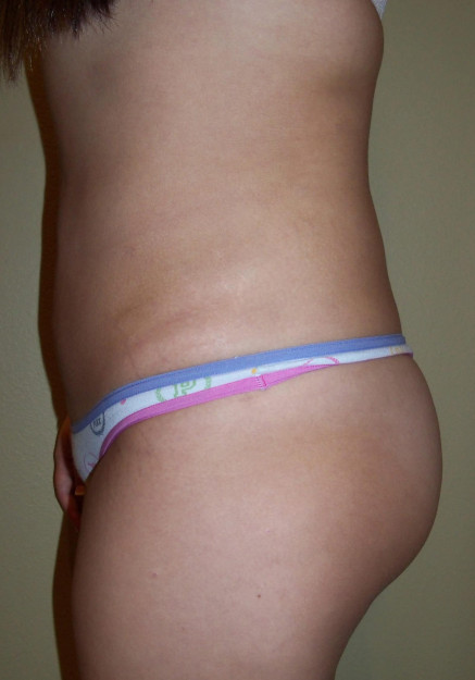 Brazilian Butt Lift – Case 10