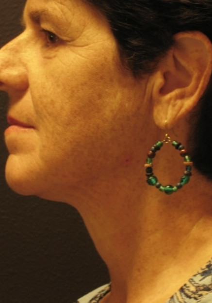 Vaser Liposuction – Case 4