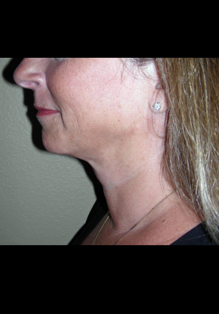 Vaser Liposuction – Case 5