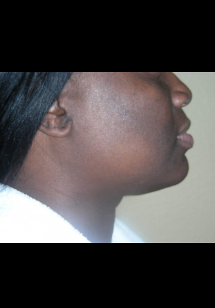 Vaser Liposuction – Case 6