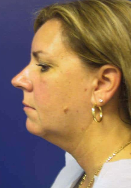 Vaser Liposuction – Case 8