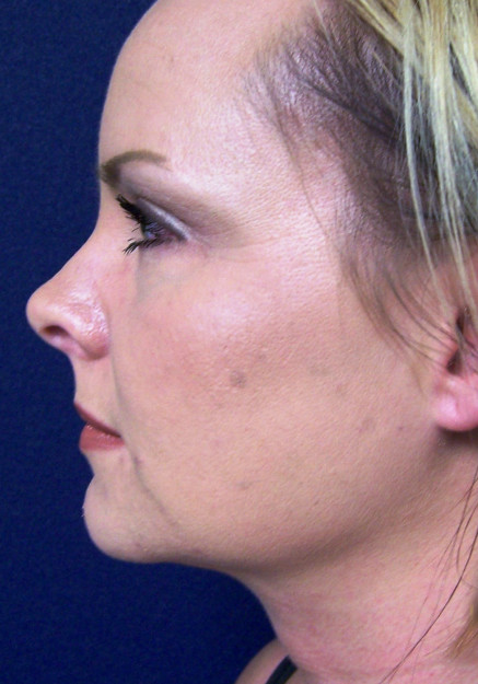 Vaser Liposuction – Case 9