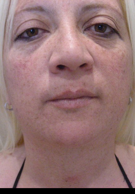 Vaser Liposuction – Case 10