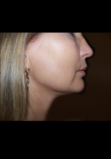 Vaser Liposuction – Case 11