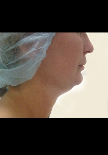 Vaser Liposuction – Case 11