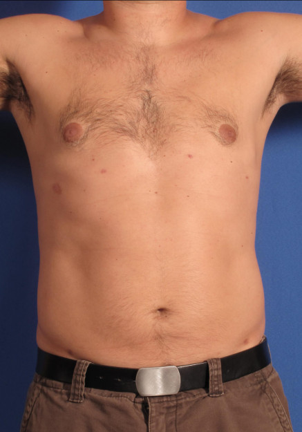Vaser Liposuction – Case 13