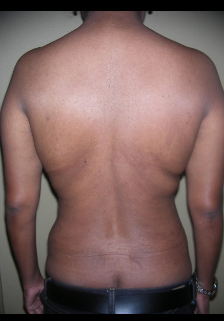 Vaser Liposuction – Case 14