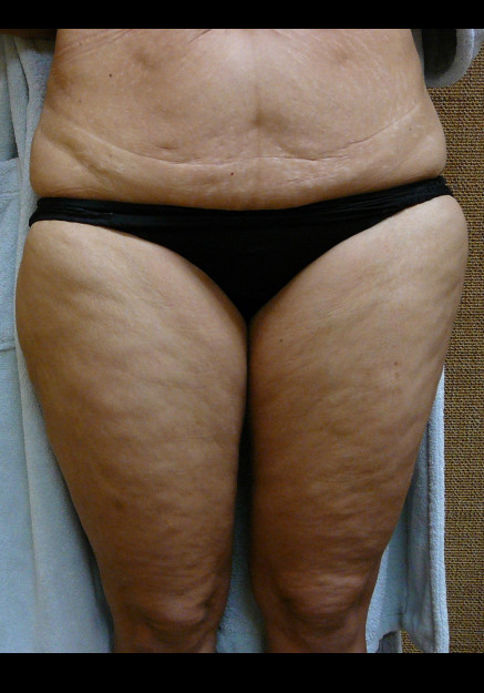 Vaser Liposuction – Case 15