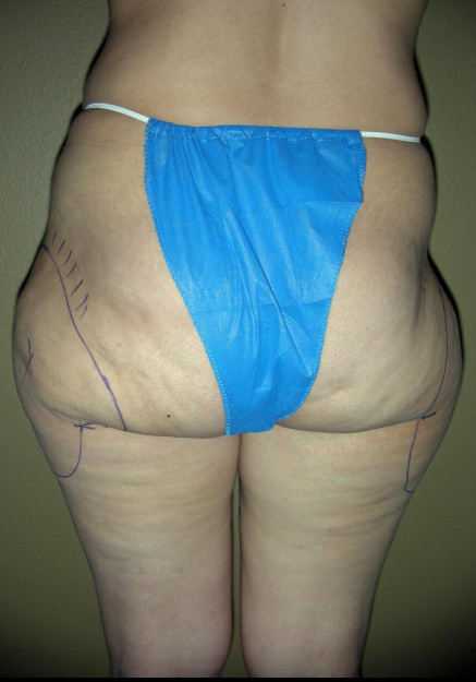 Vaser Liposuction – Case 16