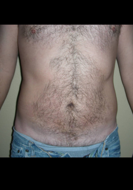 Vaser Liposuction – Case 18