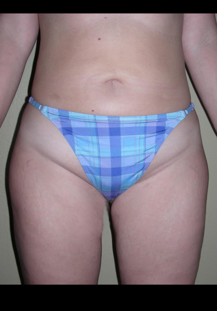Vaser Liposuction – Case 19