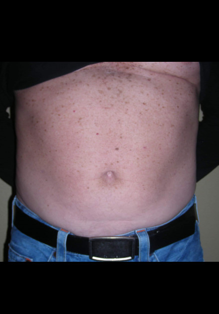 Vaser Liposuction – Case 20