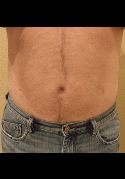 Vaser Liposuction – Case 21