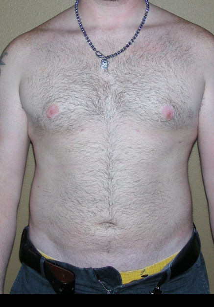 Vaser Liposuction – Case 22