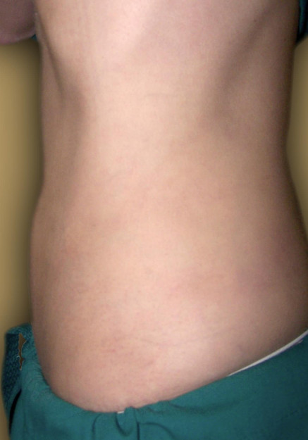 Vaser Liposuction – Case 23