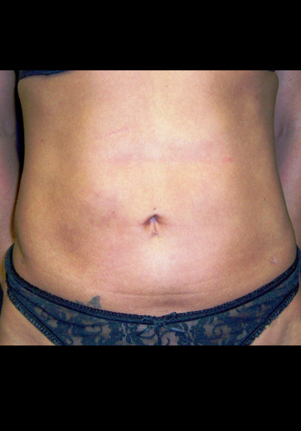 Vaser Liposuction – Case 24