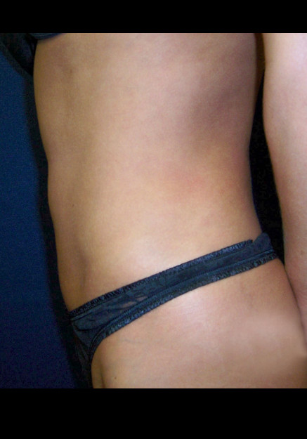 Vaser Liposuction – Case 24
